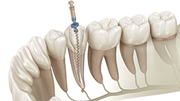 Endodoncia