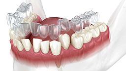 Invisalign vs. brackets: cuándo elegir cada uno